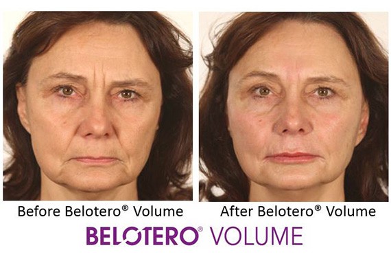Belotero by Merz